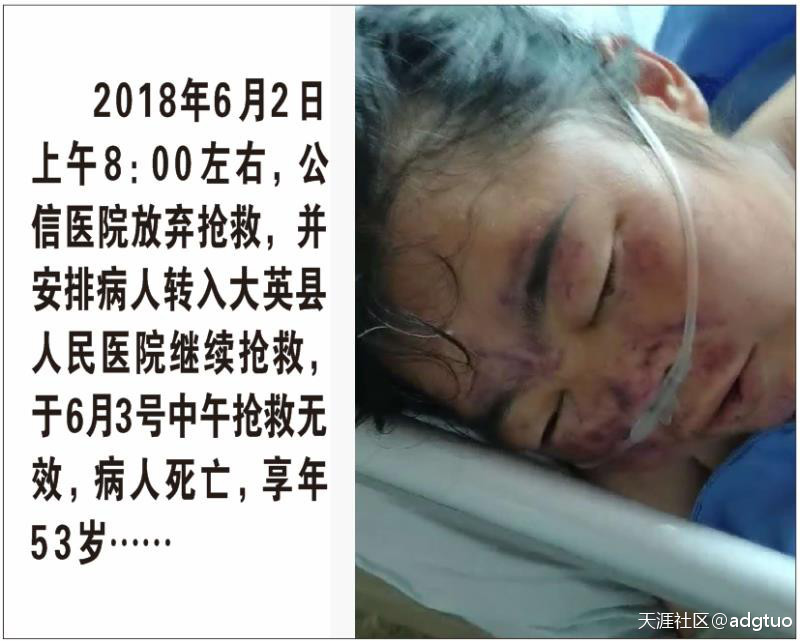 大英县公信医院因打结石给病人输液至死的几大疑点!