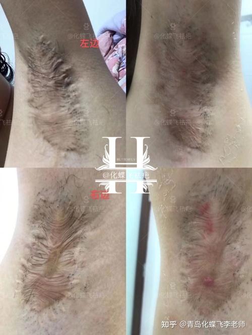 张梓琳腋下现疤痕，腋下有疤痕可能(腋下两道疤痕)