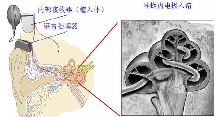 专家不建议做人工耳蜗真的吗,人工耳蜗有什么后遗症？　本文共（830字）